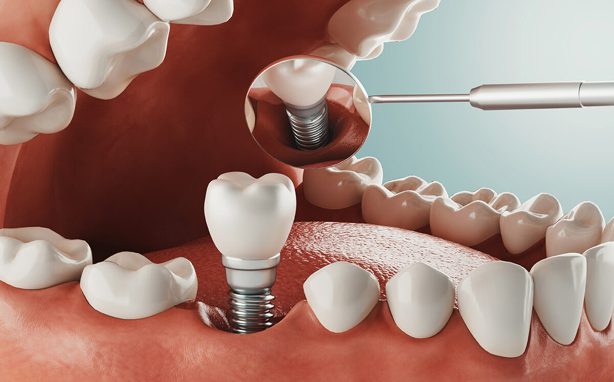 Are dental implants painful?